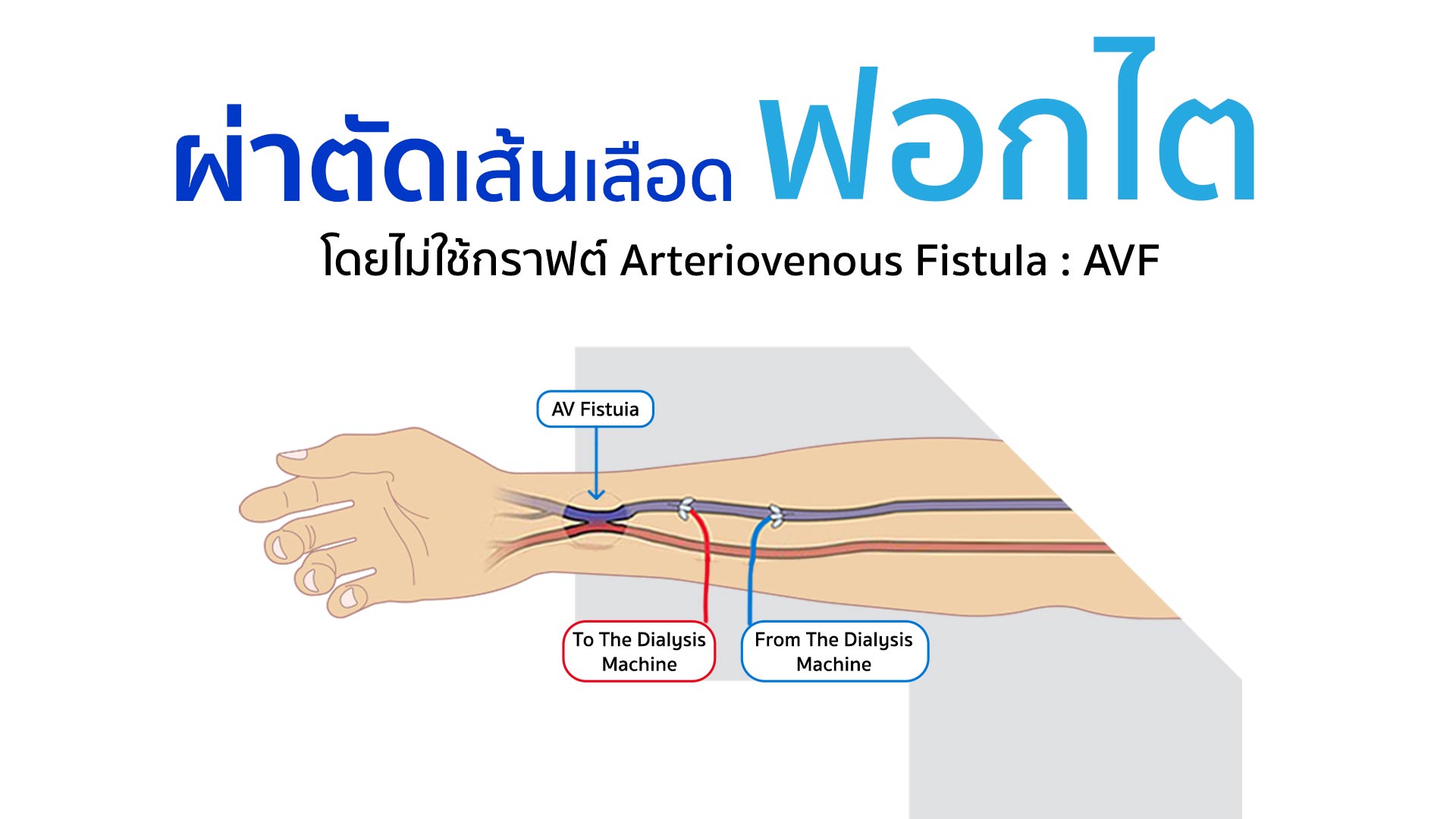 ผ่าตัดเส้นเลือดฟอกไต
