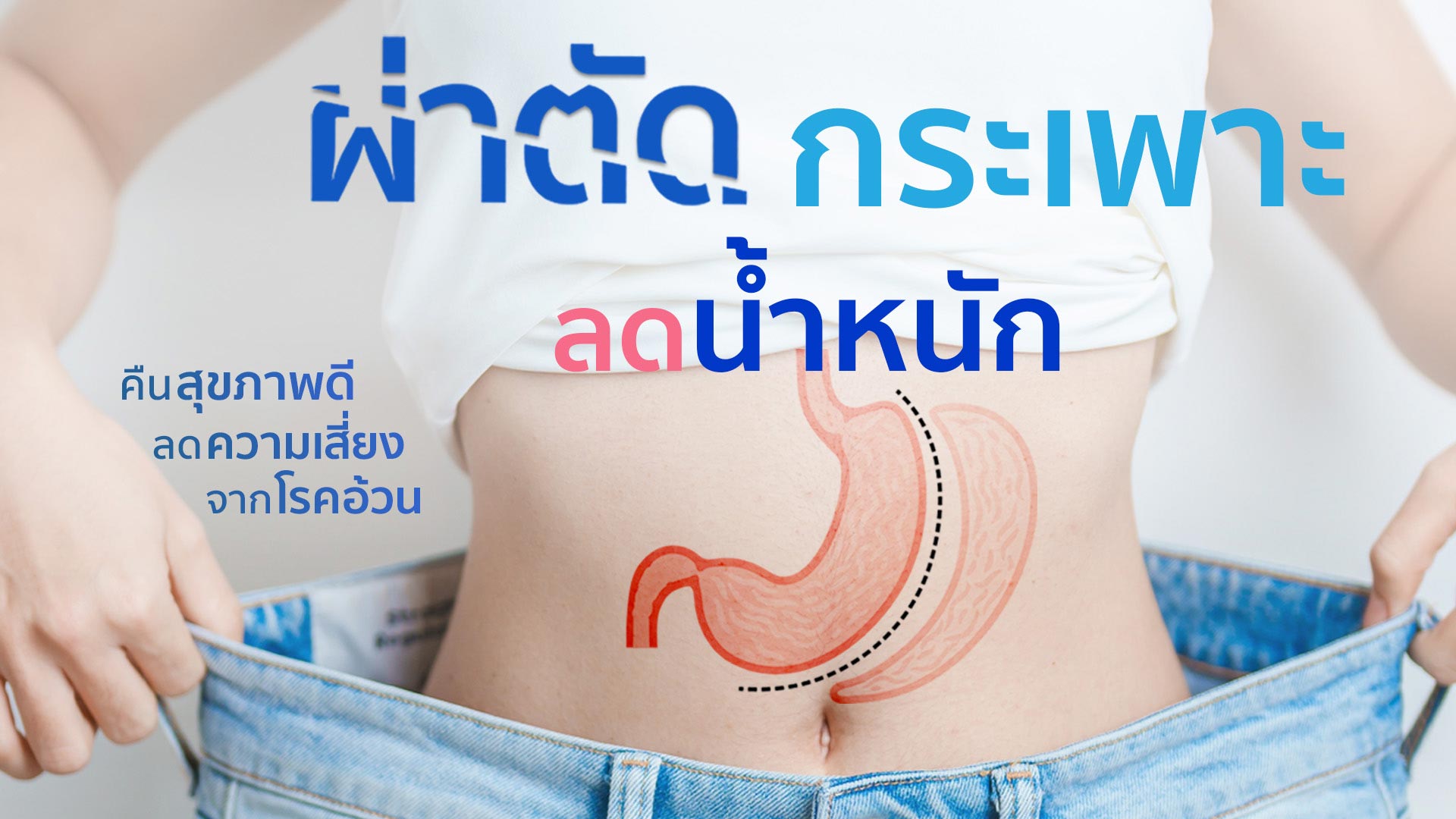 ผ่าตัดกระเพาะลดน้ำหนัก แบบส่องกล้อง : Laparoscopic Sleeve Gastrectomy