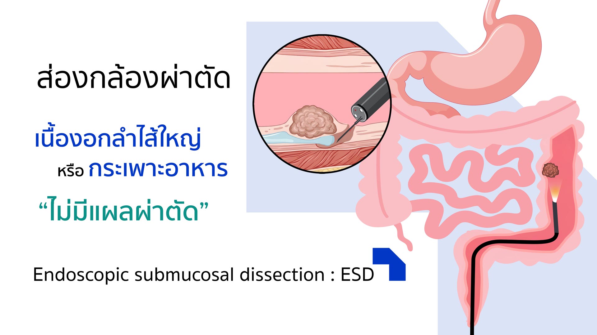 Endoscopic Submucosal Dissection (ESD)