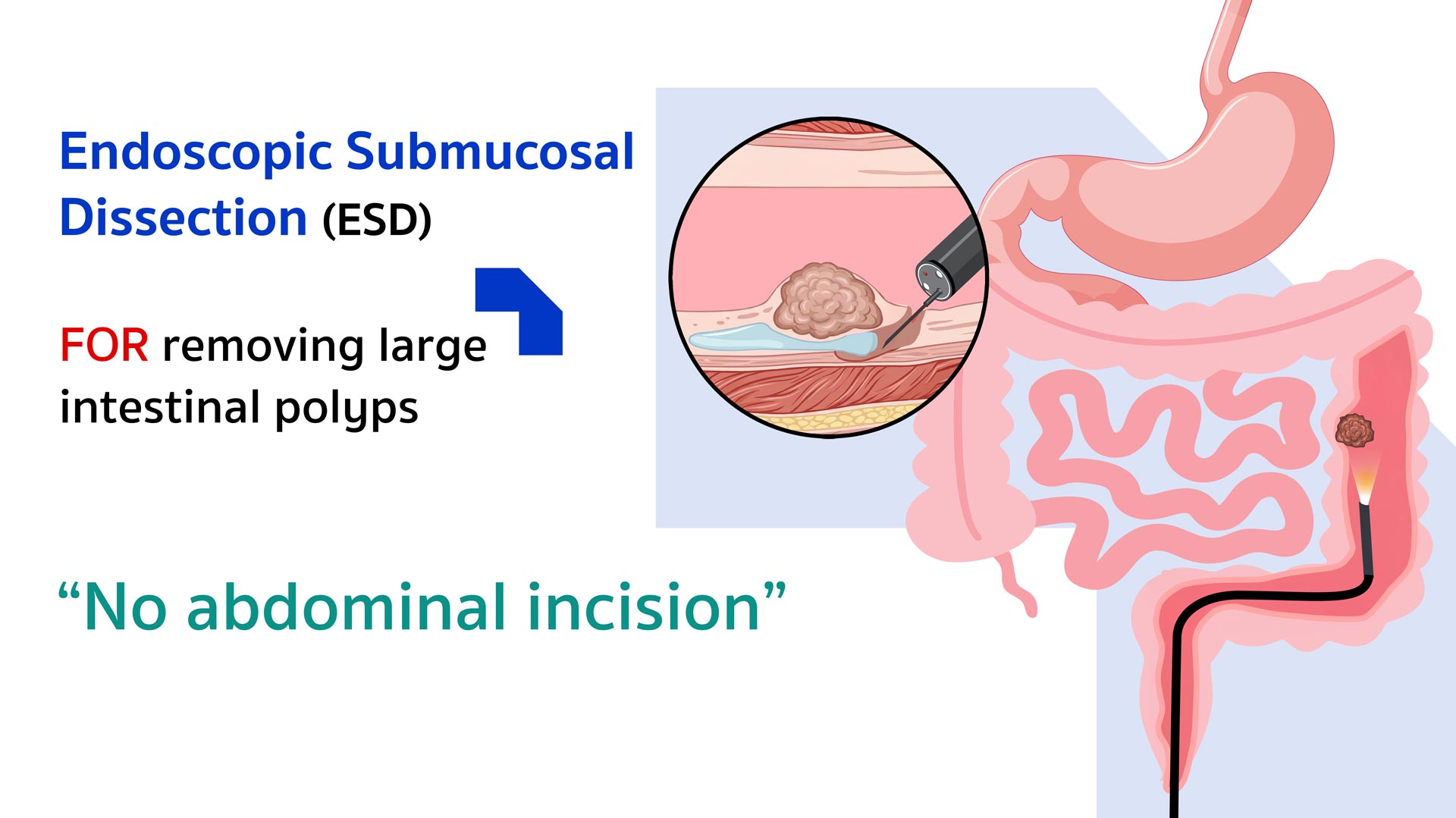 Endoscopic Submucosal Dissection (ESD)