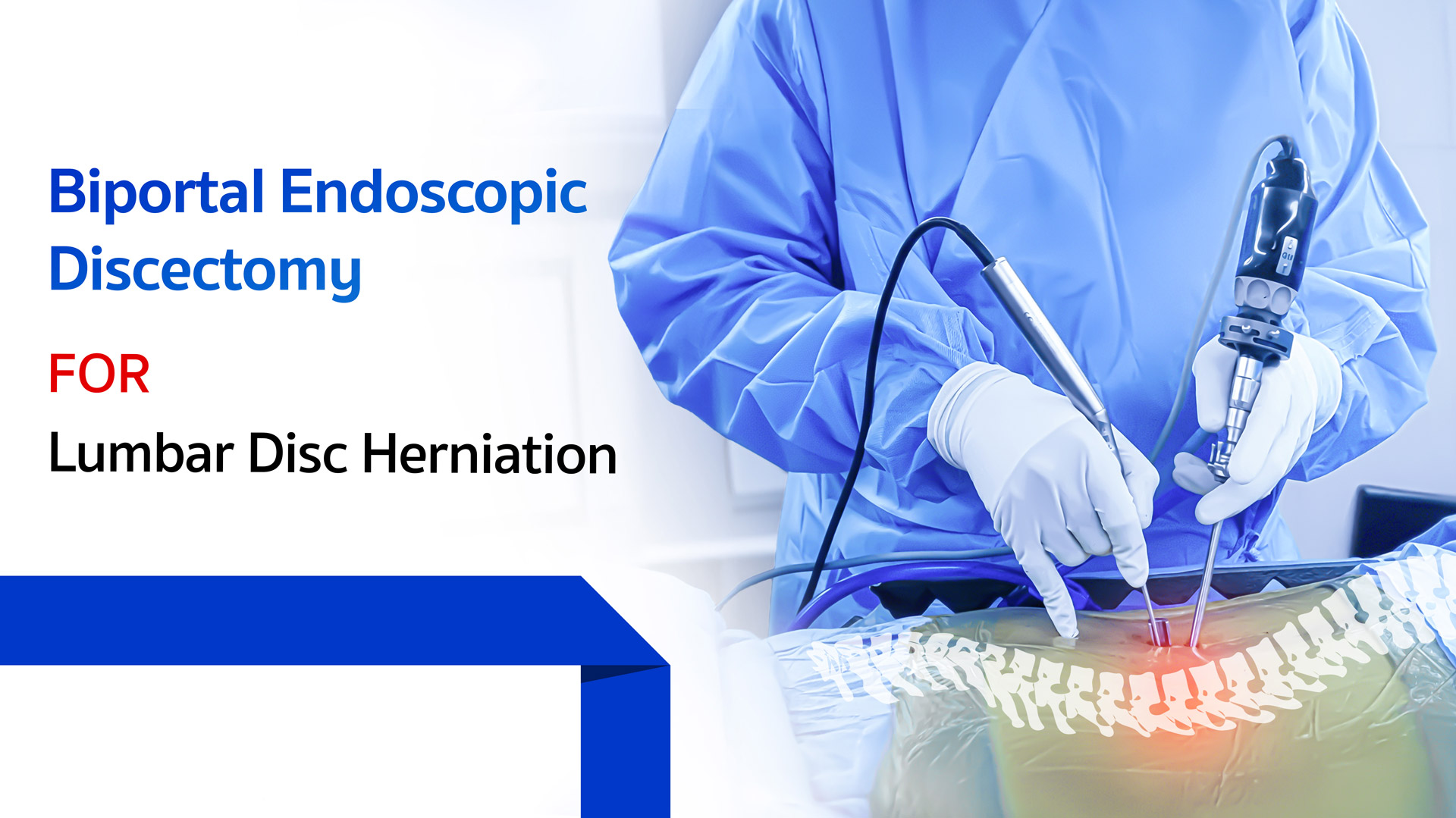 Biportal Endoscopic Discectomy