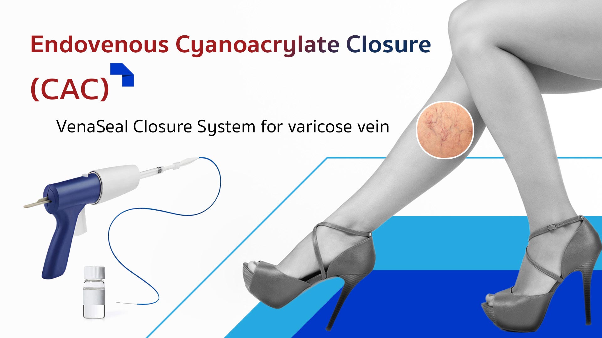 Varicose Vein Treatment with Medical Adhesive