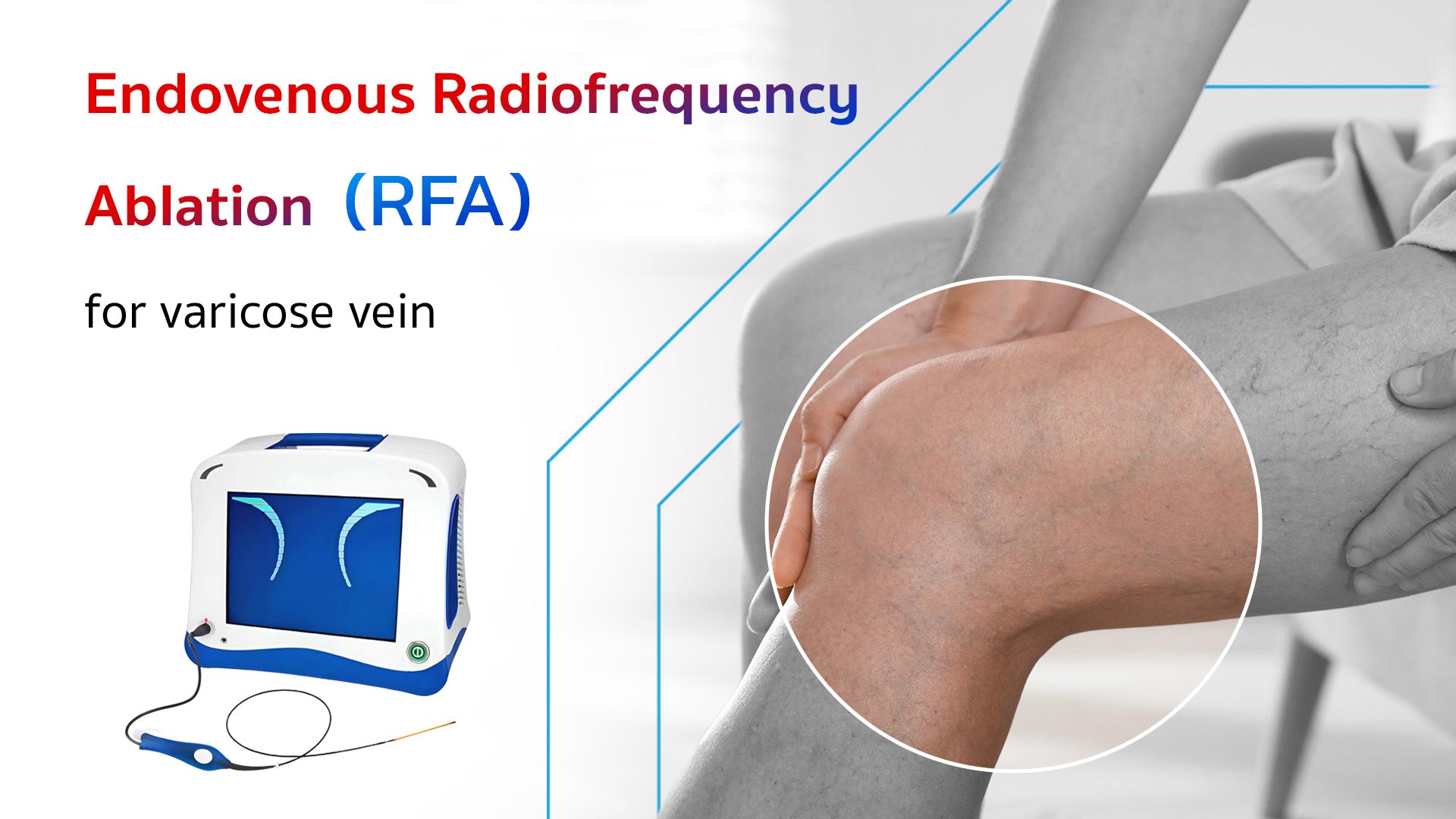 Minimally Invasive Varicose Vein Treatment (RFA)