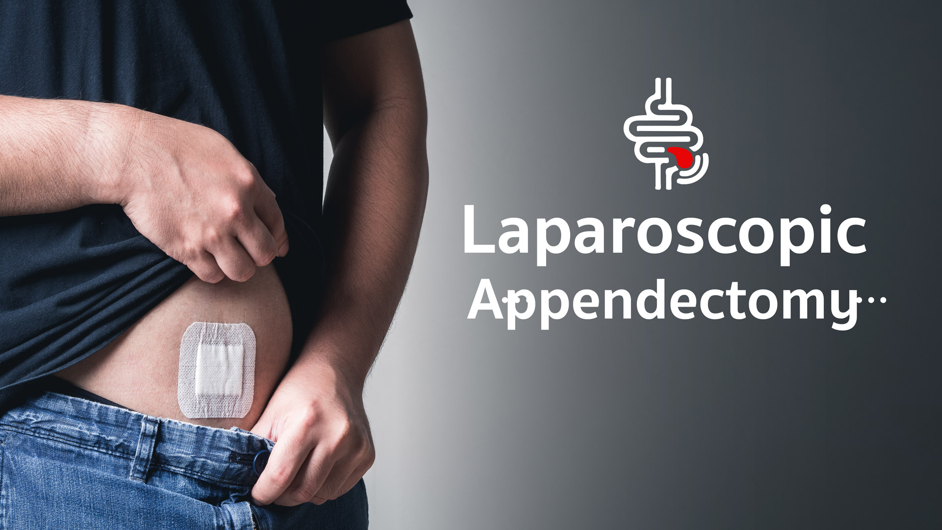 Laparoscopic Appendectomy