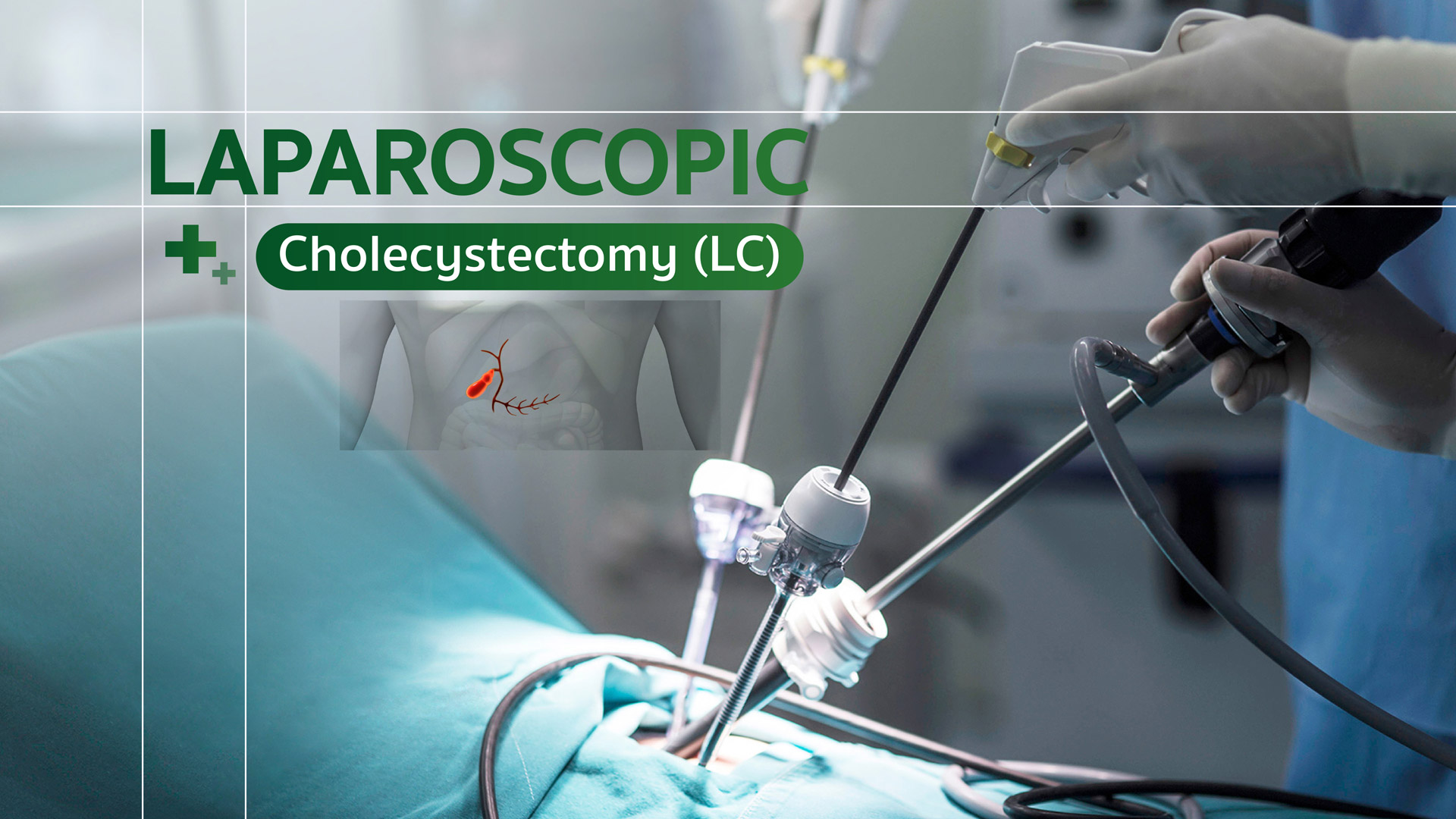Laparoscopic Cholecystectomy