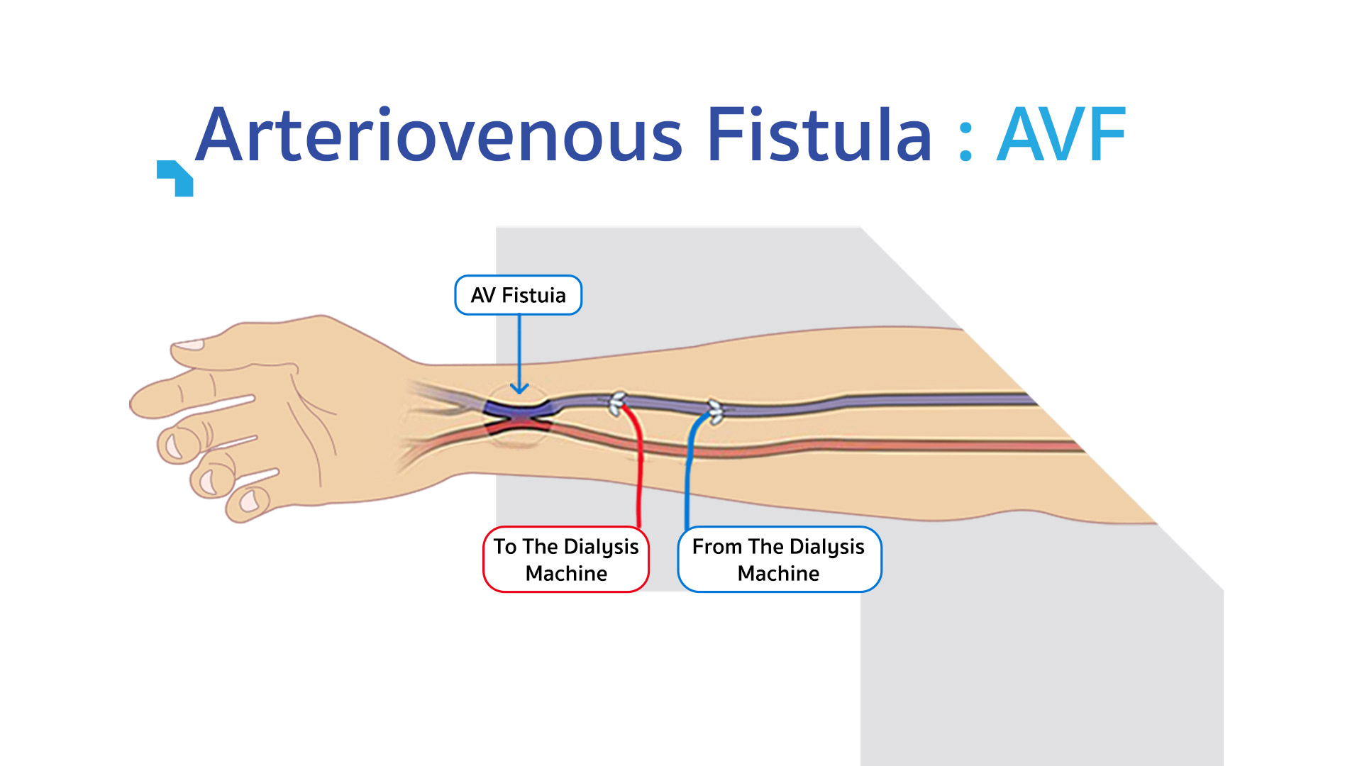 Arteriovenous Fistula (AVF) Surgery