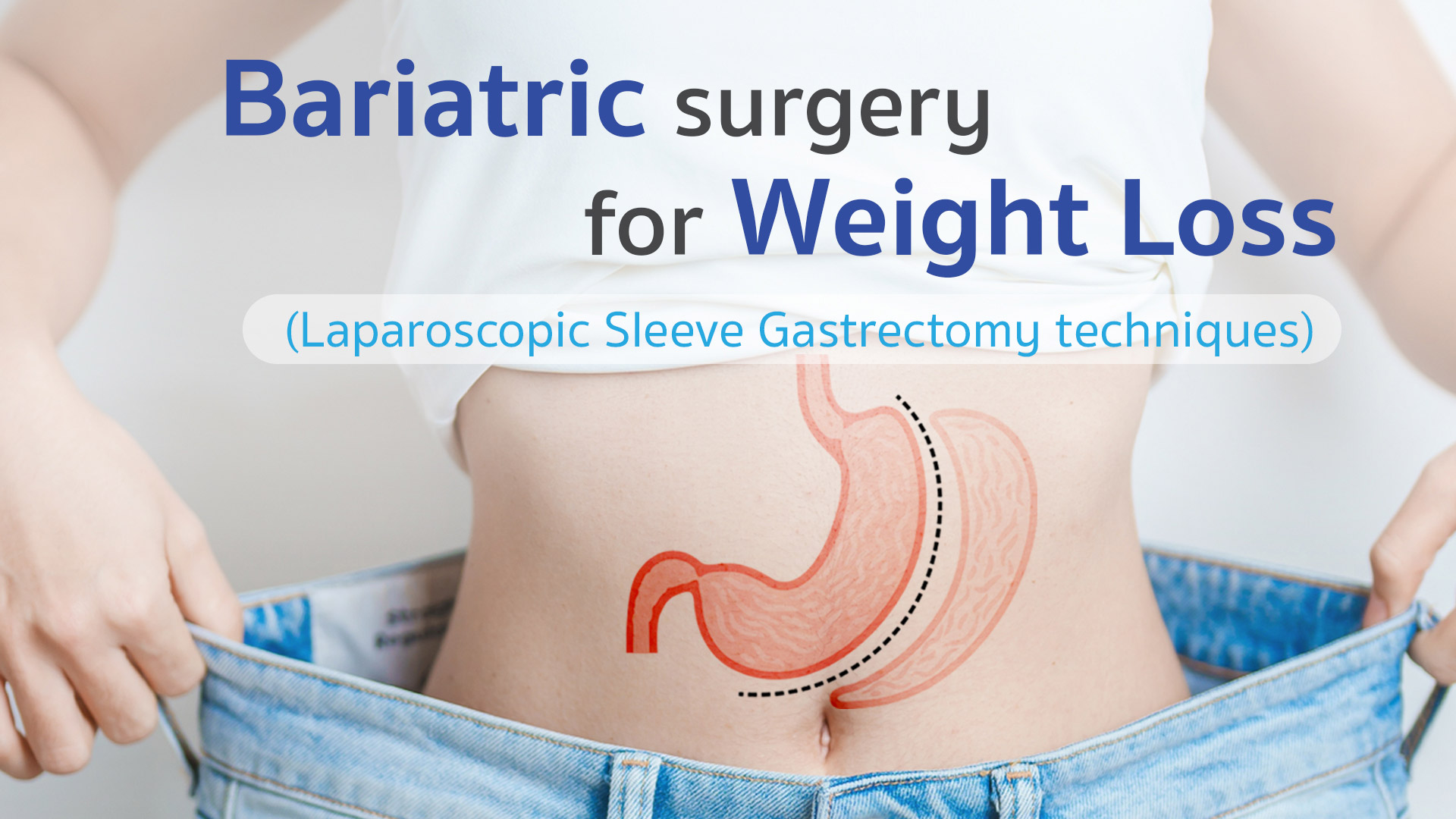 Laparoscopic Sleeve Gastrectomy: Weight Loss Surgery