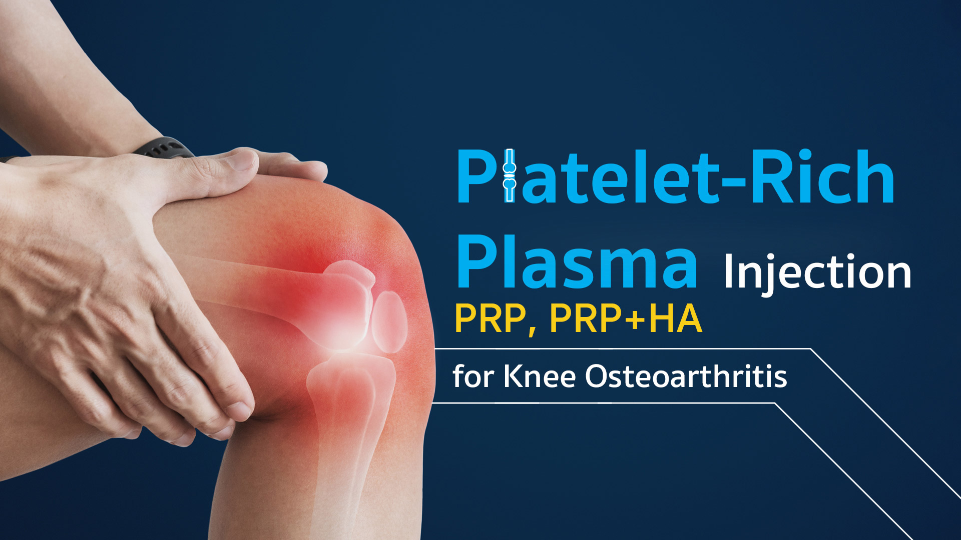 PRP Treatment for Knee Osteoarthritis