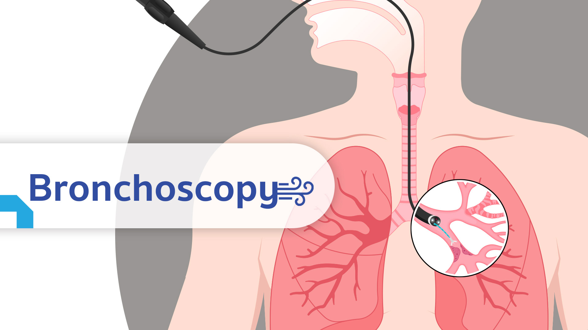 Bronchoscopy