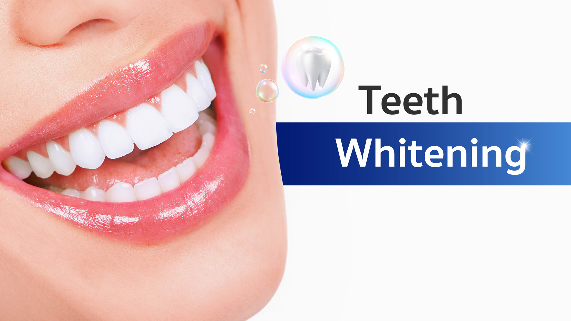 Teeth Whitening Package