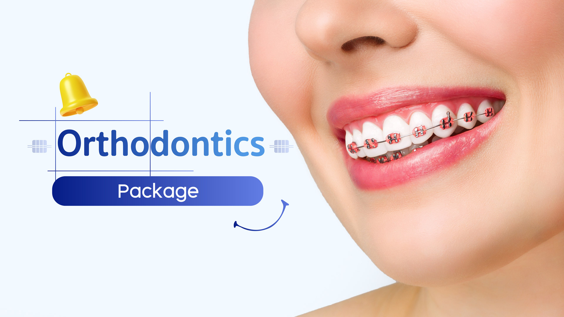 Braces Package