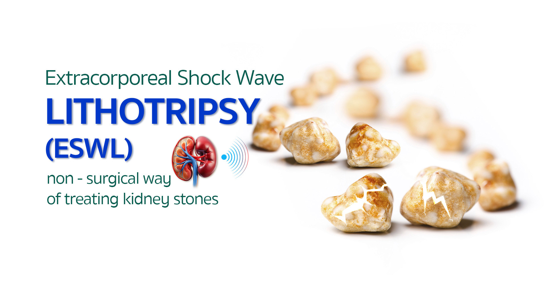 Extracorporeal Shock Wave Lithotripsy (ESWL)