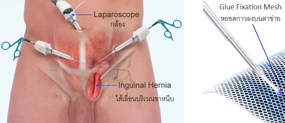 รูปการผ่าตัดไส้เลื่อนแบบส่องกล้องโดยใช้กาวติดตาข่าย (Laparoscopic Herniorrhaphy with Glue Fixation Mesh)