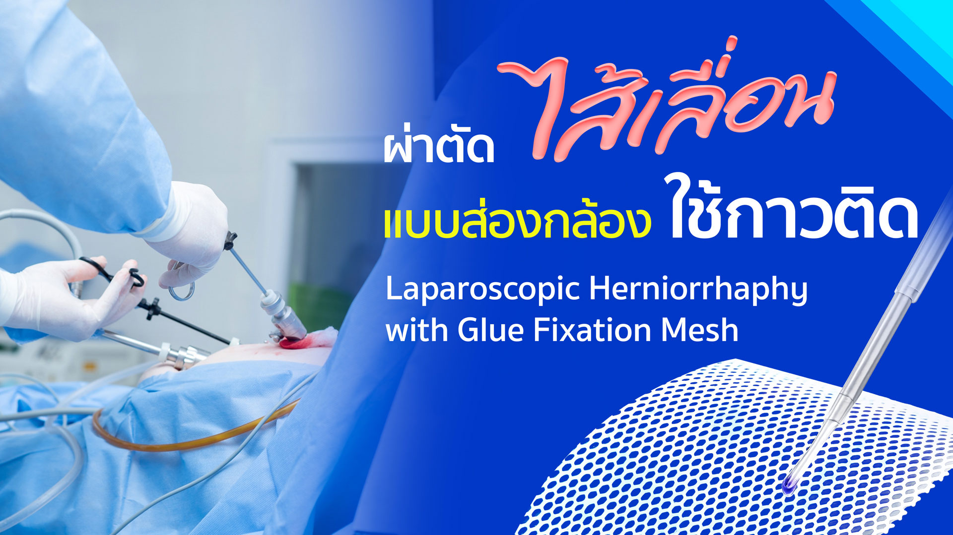  แพ็กเกจ : การผ่าตัดไส้เลื่อนแบบส่องกล้องโดยใช้กาวติดตาข่าย (Laparoscopic Herniorrhaphy with Glue Fixation Mesh) 