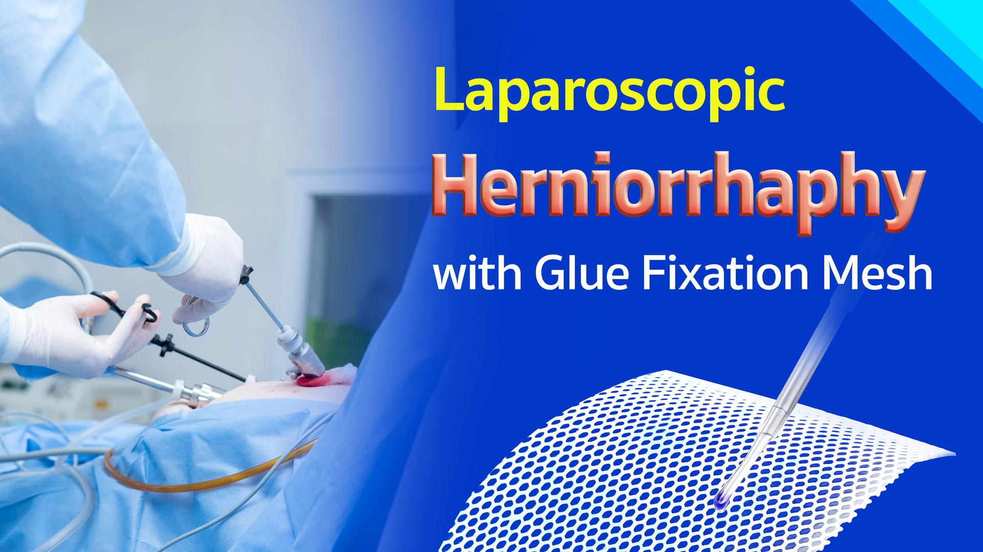 Laparoscopic Herniorrhaphy with Glue Fixation Mesh