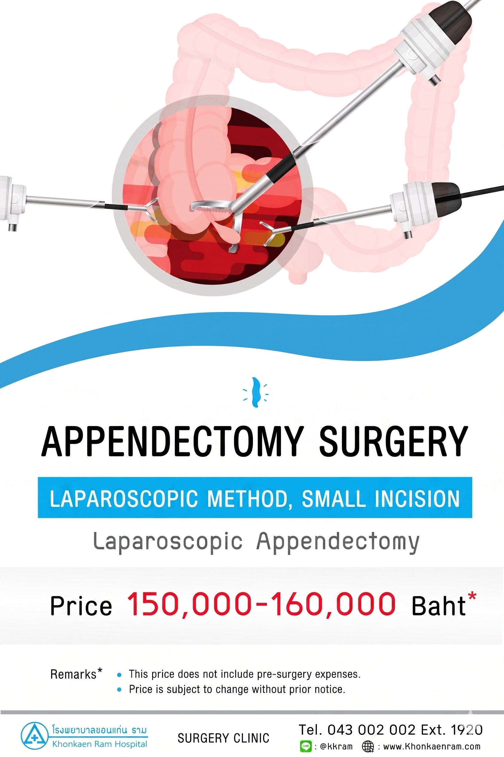 Appendectomy (Appendix Surgery)