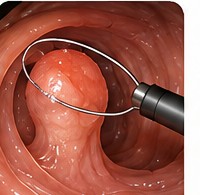 polyp removal